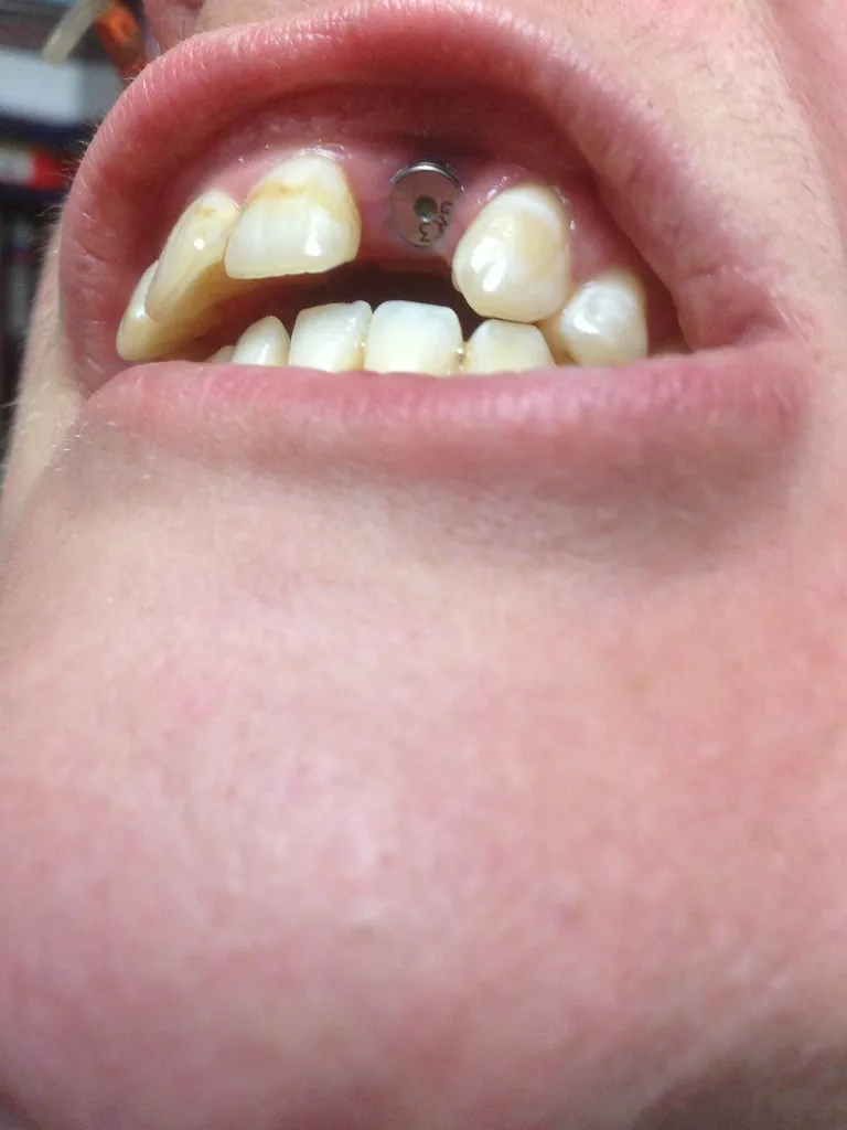 Los mejores irrigadores dentales